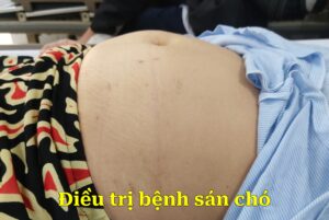 điều trị bệnh sán chó