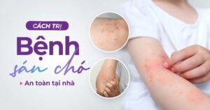 điều trị bệnh sán chó