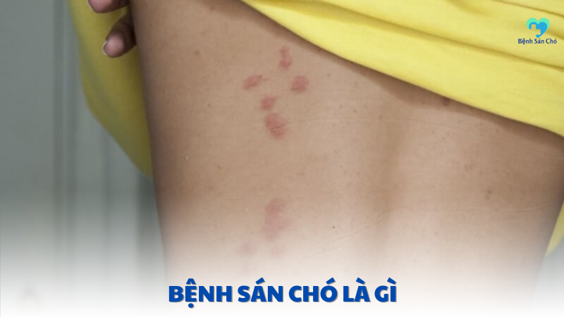 bệnh sán chó là gì