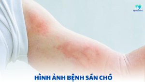 hình ảnh bệnh sán chó